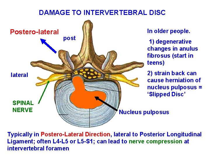 DAMAGE TO INTERVERTEBRAL DISC Postero-lateral SPINAL NERVE In older people. post 1) degenerative changes