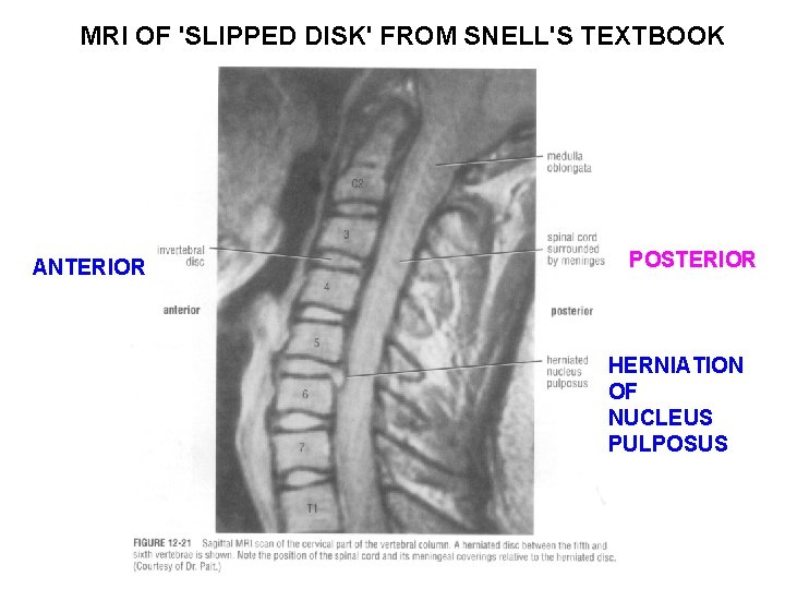 MRI OF 'SLIPPED DISK' FROM SNELL'S TEXTBOOK ANTERIOR POSTERIOR HERNIATION OF NUCLEUS PULPOSUS 