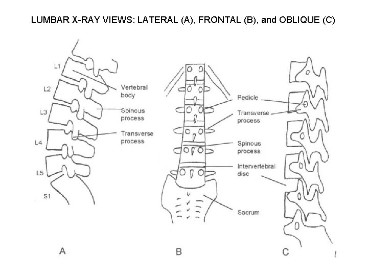 LUMBAR X-RAY VIEWS: LATERAL (A), FRONTAL (B), and OBLIQUE (C) 