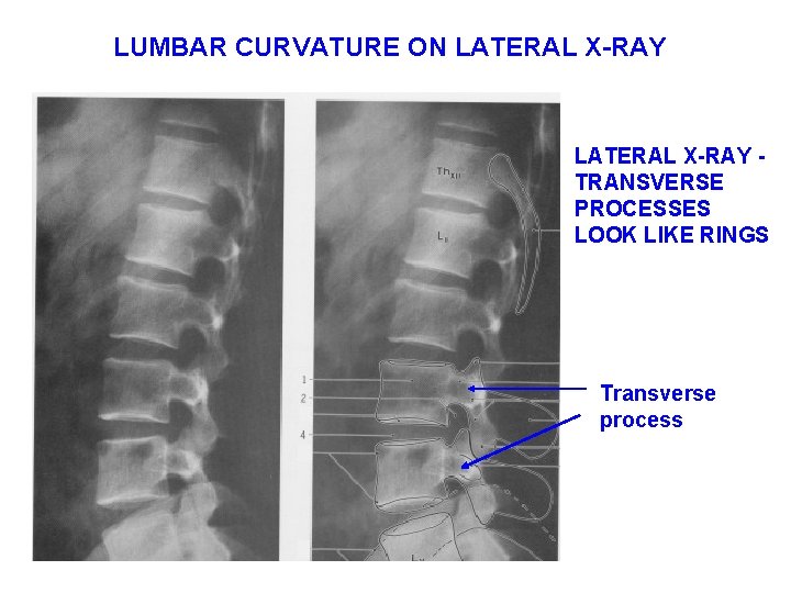 LUMBAR CURVATURE ON LATERAL X-RAY TRANSVERSE PROCESSES LOOK LIKE RINGS Transverse process 