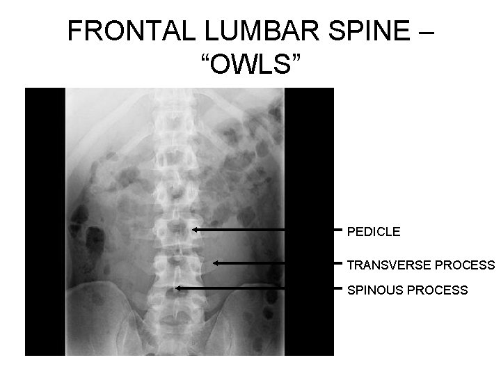 FRONTAL LUMBAR SPINE – “OWLS” PEDICLE TRANSVERSE PROCESS SPINOUS PROCESS 