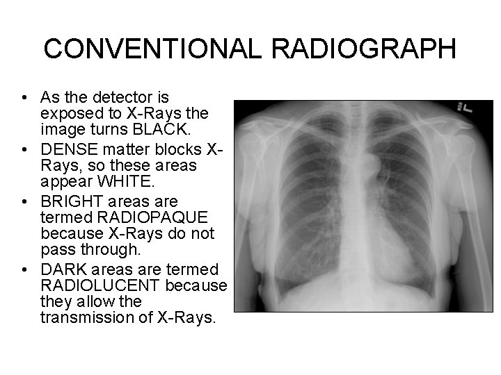 CONVENTIONAL RADIOGRAPH • As the detector is exposed to X-Rays the image turns BLACK.