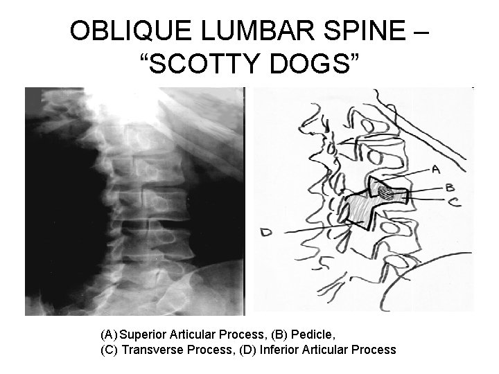 OBLIQUE LUMBAR SPINE – “SCOTTY DOGS” (A) Superior Articular Process, (B) Pedicle, (C) Transverse