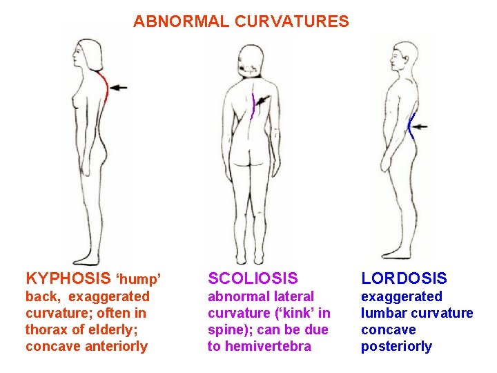 ABNORMAL CURVATURES KYPHOSIS ‘hump’ SCOLIOSIS LORDOSIS back, exaggerated curvature; often in thorax of elderly;