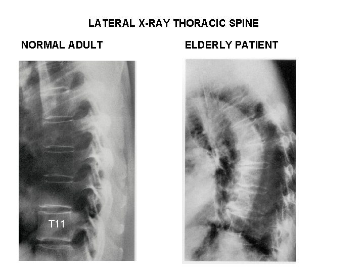 LATERAL X-RAY THORACIC SPINE NORMAL ADULT T 11 ELDERLY PATIENT 