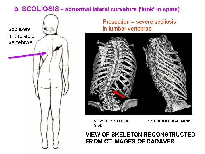 b. SCOLIOSIS - abnormal lateral curvature (‘kink’ in spine) scoliosis in thoracic vertebrae Prosection