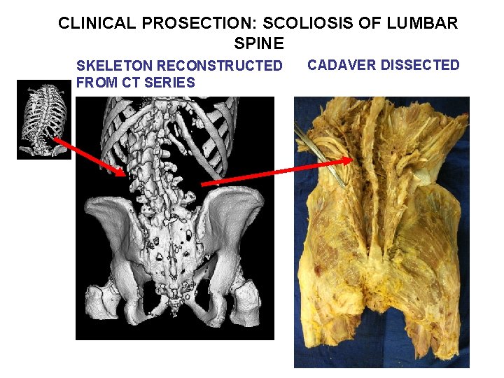 CLINICAL PROSECTION: SCOLIOSIS OF LUMBAR SPINE SKELETON RECONSTRUCTED FROM CT SERIES CADAVER DISSECTED 