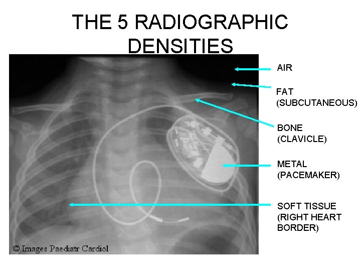 THE 5 RADIOGRAPHIC DENSITIES AIR FAT (SUBCUTANEOUS) BONE (CLAVICLE) METAL (PACEMAKER) SOFT TISSUE (RIGHT