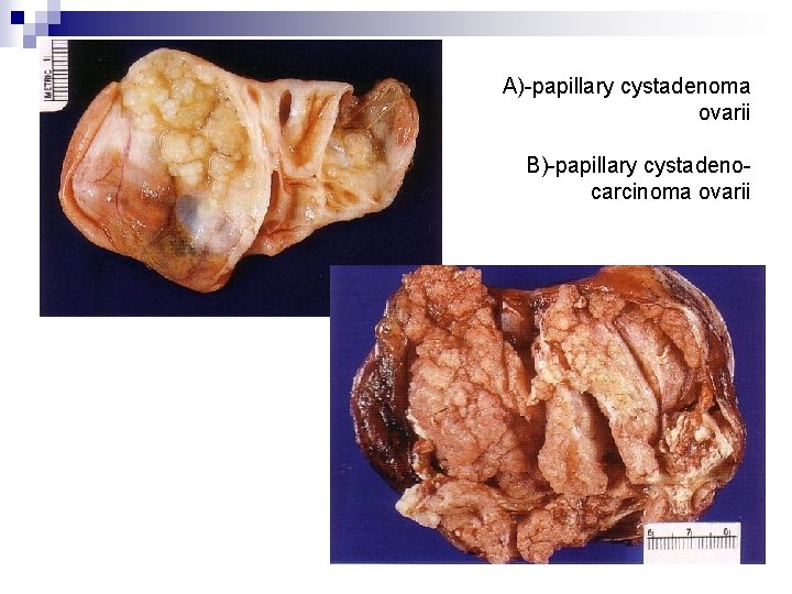 A)-papillary cystadenoma ovarii B)-papillary cystadenocarcinoma ovarii 