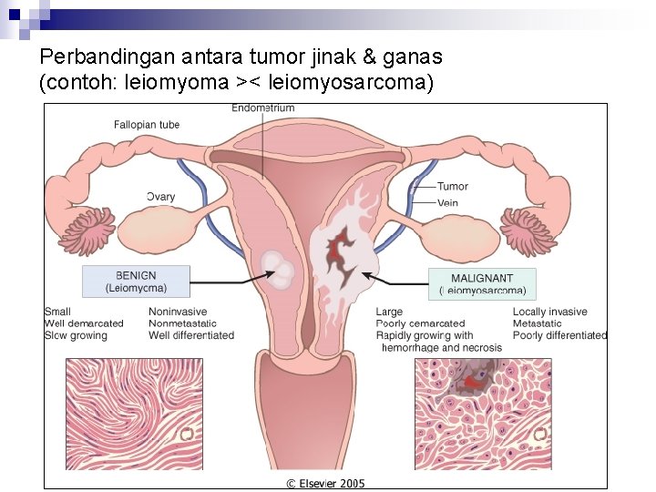 Perbandingan antara tumor jinak & ganas (contoh: leiomyoma >< leiomyosarcoma) 