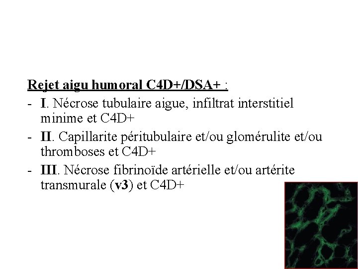 Rejet aigu humoral C 4 D+/DSA+ : - I. Nécrose tubulaire aigue, infiltrat interstitiel