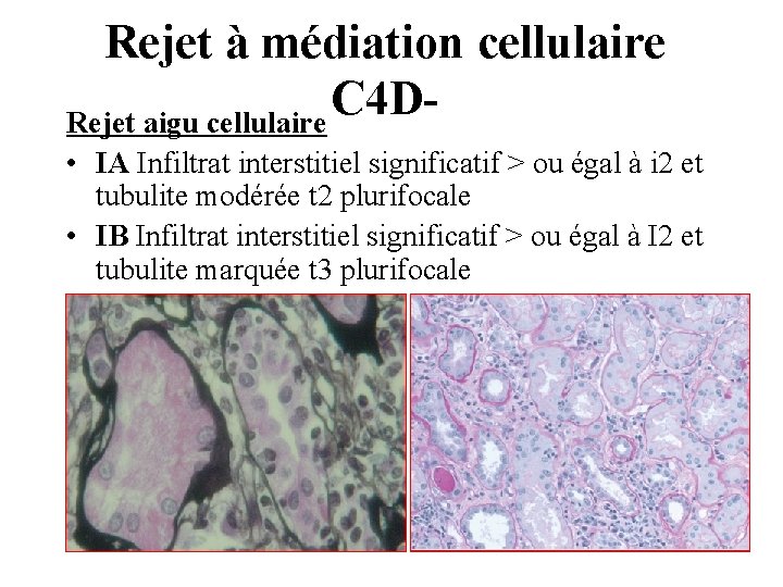 Rejet à médiation cellulaire C 4 DRejet aigu cellulaire • IA Infiltrat interstitiel significatif