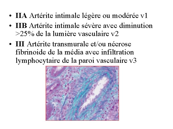  • IIA Artérite intimale légère ou modérée v 1 • IIB Artérite intimale