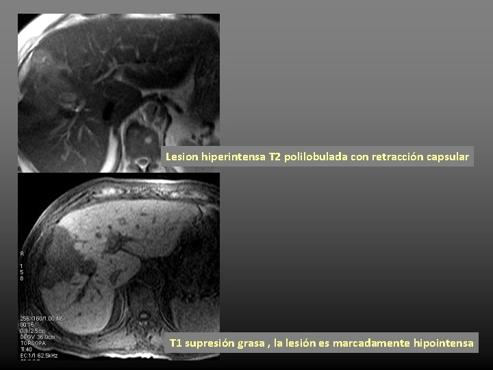 Lesion hiperintensa T 2 polilobulada con retracción capsular T 1 supresión grasa , la