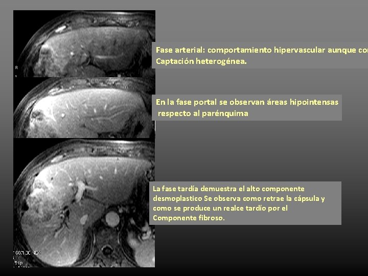 Fase arterial: comportamiento hipervascular aunque con Captación heterogénea. En la fase portal se observan