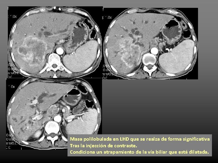 Masa polilobulada en LHD que se realza de forma significativa Tras la injección de