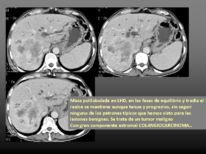 Masa polilobulada en LHD, en las fases de equilibrio y tradia el realce se