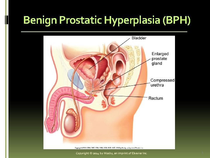 Benign Prostatic Hyperplasia (BPH) Copyright © 2014 by Mosby, an imprint of Elsevier Inc.