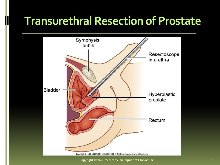 Transurethral Resection of Prostate Copyright © 2014 by Mosby, an imprint of Elsevier Inc.