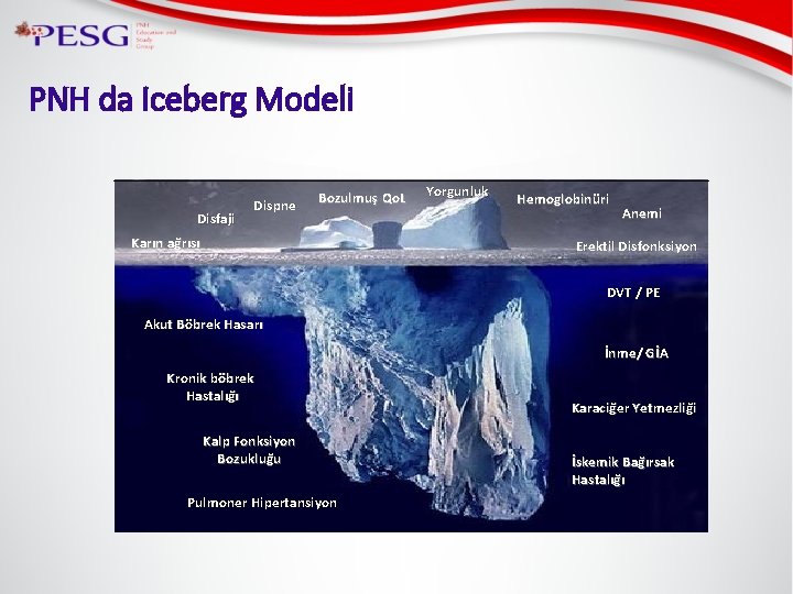PNH da Iceberg Modeli Disfaji Dispne Yorgunluk Bozulmuş Qo. L Karın ağrısı Hemoglobinüri Anemi
