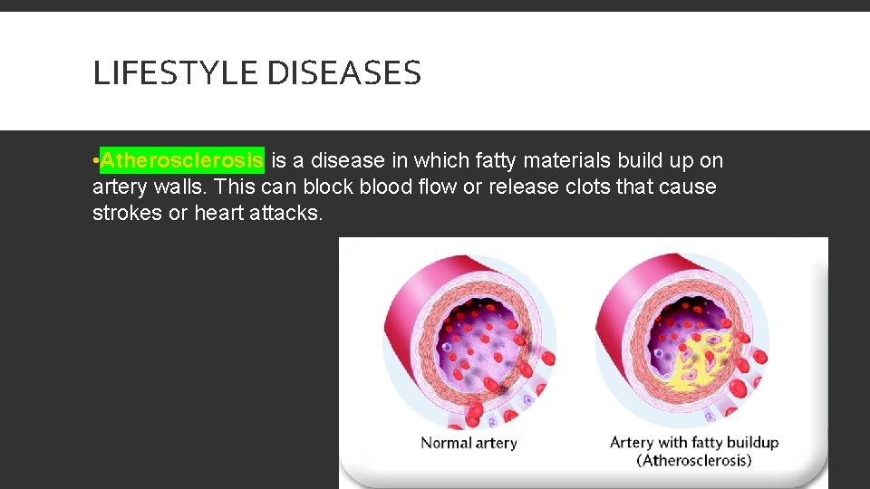 LIFESTYLE DISEASES • Atherosclerosis is a disease in which fatty materials build up on