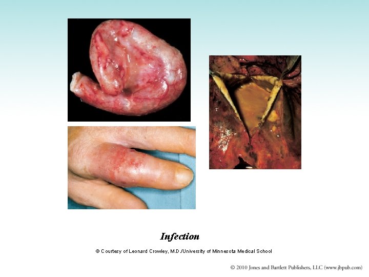 Infection © Courtesy of Leonard Crowley, M. D. /University of Minnesota Medical School 