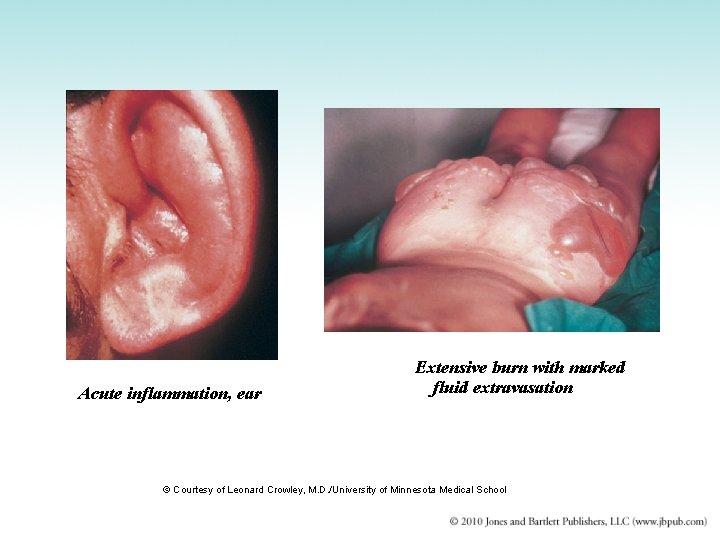 Acute inflammation, ear Extensive burn with marked fluid extravasation © Courtesy of Leonard Crowley,