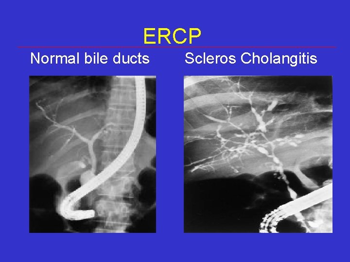 ERCP Normal bile ducts Scleros Cholangitis ERCP Normal bile ducts Scleros Cholangitis