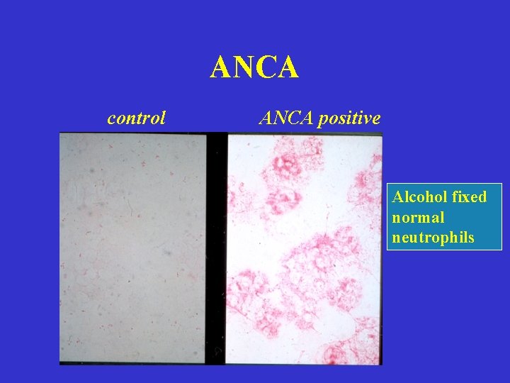 ANCA control ANCA positive Alcohol fixed normal neutrophils ANCA control ANCA positive Alcohol fixed normal neutrophils