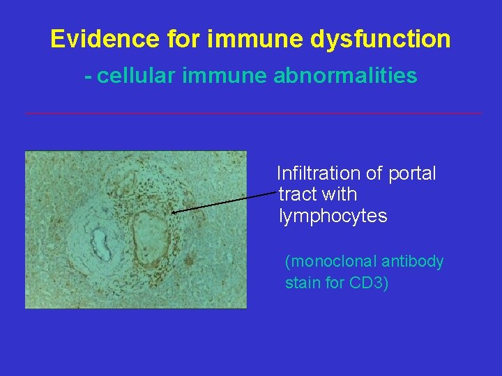 Evidence for immune dysfunction - cellular immune abnormalities Infiltration of portal tract with lymphocytes Evidence for immune dysfunction - cellular immune abnormalities Infiltration of portal tract with lymphocytes