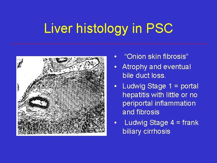 Liver histology in PSC • “Onion skin fibrosis” • Atrophy and eventual bile duct Liver histology in PSC • “Onion skin fibrosis” • Atrophy and eventual bile duct