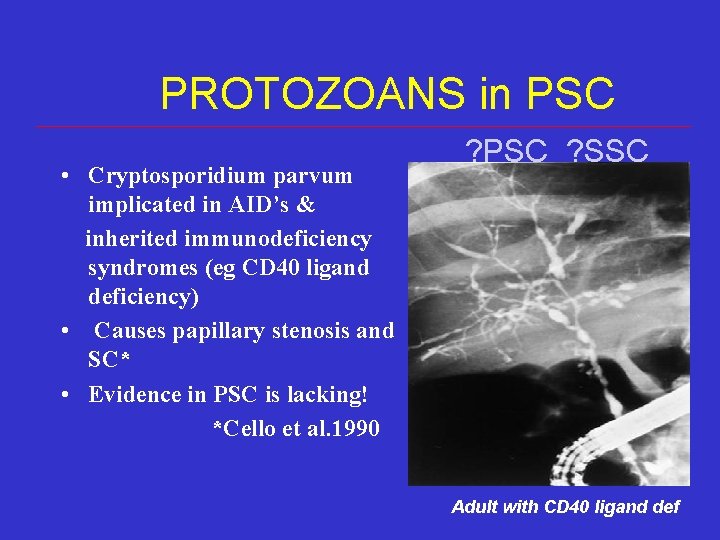 PROTOZOANS in PSC • Cryptosporidium parvum implicated in AID’s & inherited immunodeficiency syndromes (eg PROTOZOANS in PSC • Cryptosporidium parvum implicated in AID’s & inherited immunodeficiency syndromes (eg