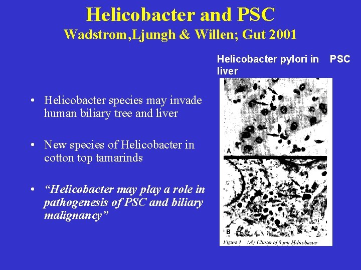 Helicobacter and PSC Wadstrom, Ljungh & Willen; Gut 2001 Helicobacter pylori in liver • Helicobacter and PSC Wadstrom, Ljungh & Willen; Gut 2001 Helicobacter pylori in liver •