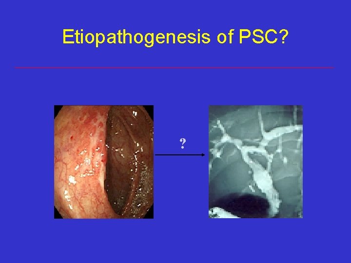 Etiopathogenesis of PSC? ? Etiopathogenesis of PSC? ?
