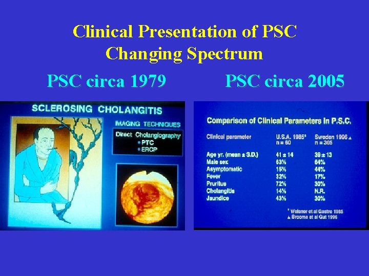 Clinical Presentation of PSC Changing Spectrum PSC circa 1979 PSC circa 2005 Clinical Presentation of PSC Changing Spectrum PSC circa 1979 PSC circa 2005