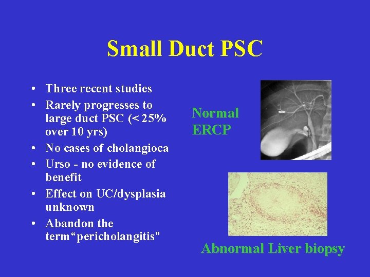 Small Duct PSC • Three recent studies • Rarely progresses to large duct PSC Small Duct PSC • Three recent studies • Rarely progresses to large duct PSC