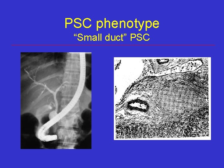 PSC phenotype “Small duct” PSC PSC phenotype “Small duct” PSC