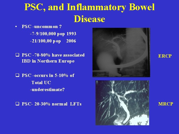 PSC, and Inflammatory Bowel Disease • PSC -uncommon ? -7 -9/100, 000 pop 1993 PSC, and Inflammatory Bowel Disease • PSC -uncommon ? -7 -9/100, 000 pop 1993