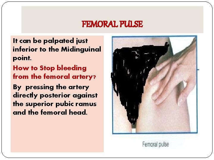 FEMORAL PULSE It can be palpated just inferior to the Midinguinal point. How to