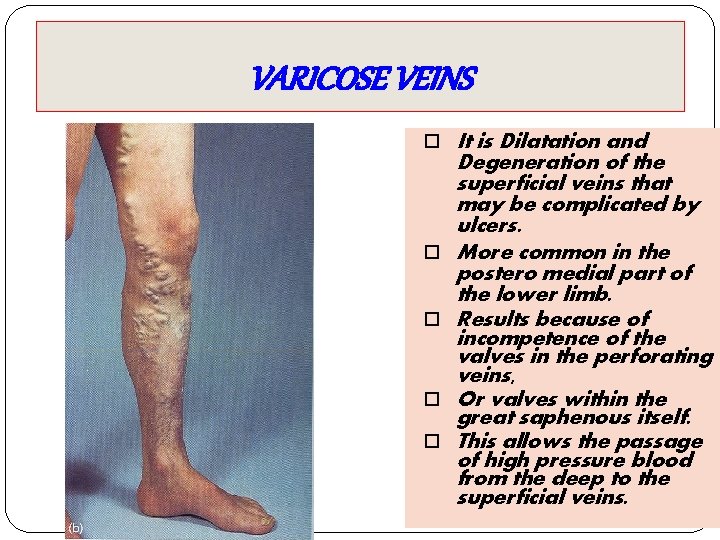 VARICOSE VEINS It is Dilatation and Degeneration of the superficial veins that may be