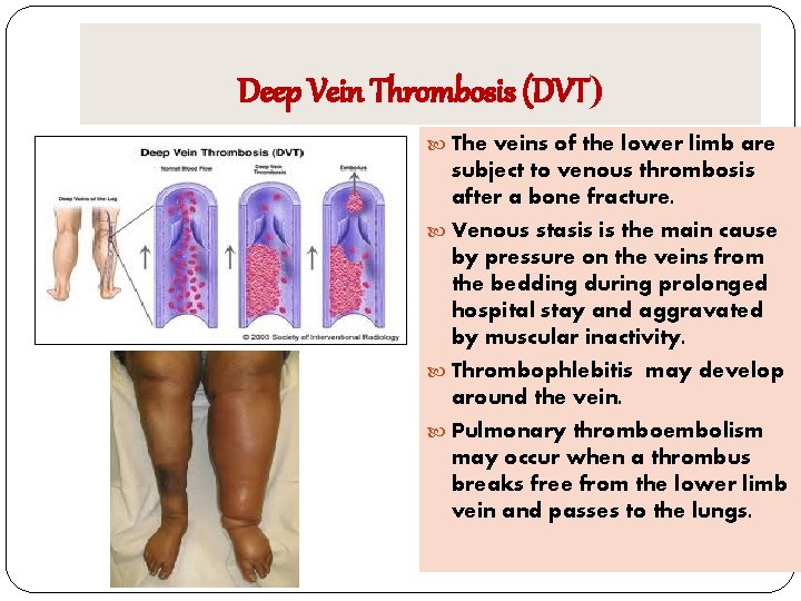 Deep Vein Thrombosis (DVT) The veins of the lower limb are subject to venous