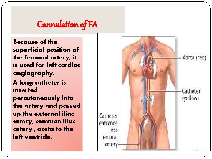 Cannulation of FA Because of the superficial position of the femoral artery, it is