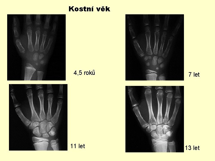 Kostní věk 4, 5 roků 11 let 7 let 13 let 