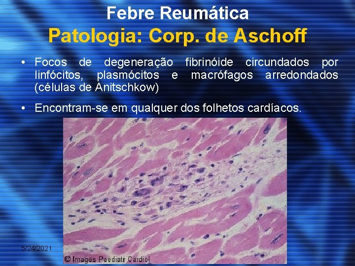 Febre Reumática Patologia: Corp. de Aschoff • Focos de degeneração fibrinóide circundados por linfócitos,