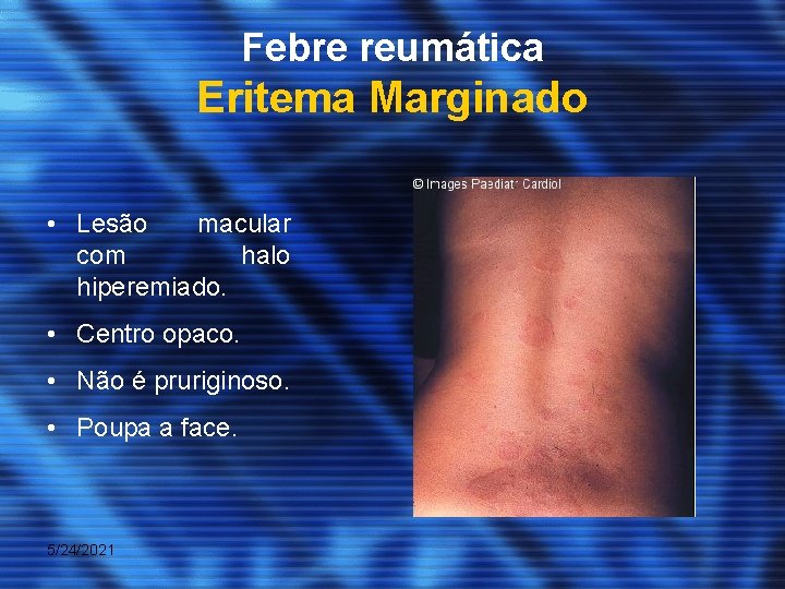 Febre reumática Eritema Marginado • Lesão macular com halo hiperemiado. • Centro opaco. •