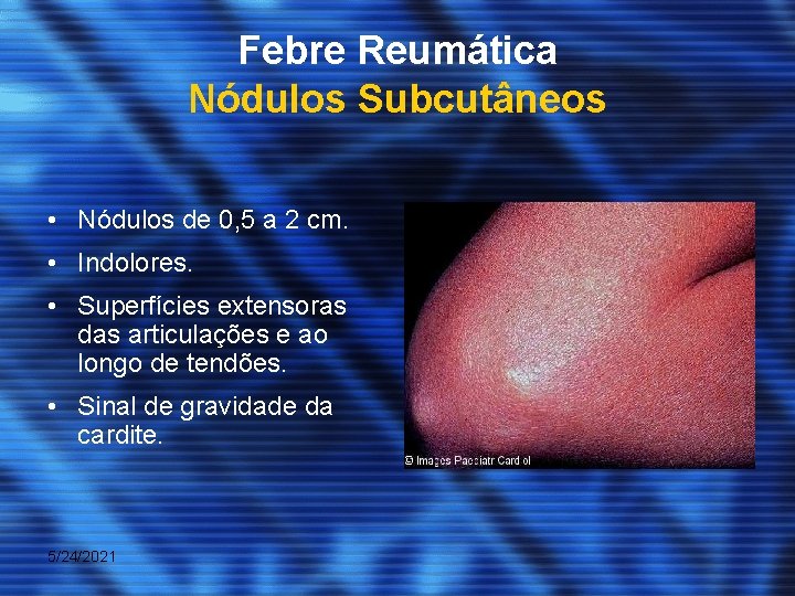 Febre Reumática Nódulos Subcutâneos • Nódulos de 0, 5 a 2 cm. • Indolores.