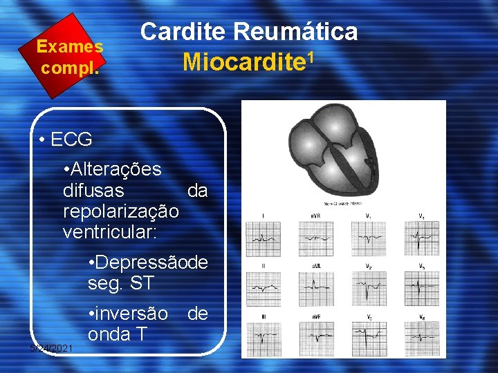Exames compl. Cardite Reumática Miocardite 1 • ECG • Alterações difusas da repolarização ventricular: