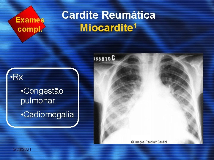 Exames compl. Cardite Reumática Miocardite 1 • Rx • Congestão pulmonar. • Cadiomegalia 5/24/2021