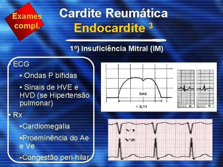 Exames compl. Cardite Reumática Endocardite 3 1º) Insuficiência Mitral (IM) • ECG • Ondas