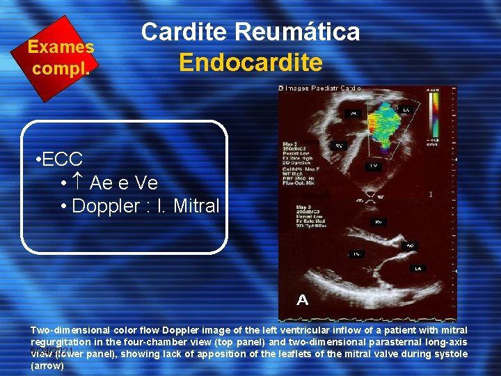 Exames compl. Cardite Reumática Endocardite • ECC • Ae e Ve • Doppler :